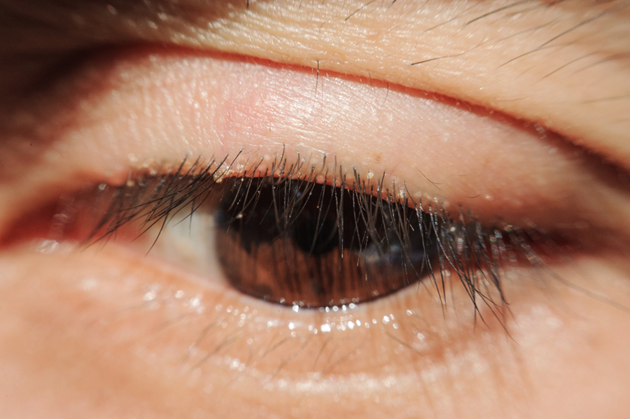 close up Blepharitis or Eyelid inflammation 
