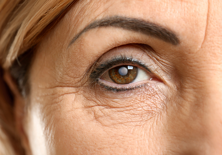 Cataract concept. Senior woman's eye, closeup