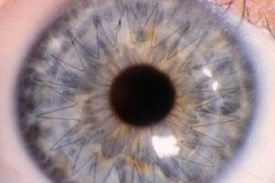 Corneal Cross Linking