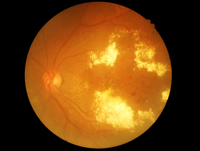 diabetic retinophaty