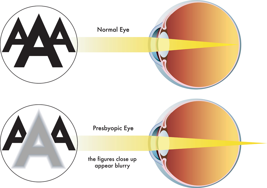 Medical illustration of the symptoms of presbyopia.